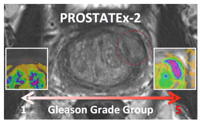 PROSTATEx2